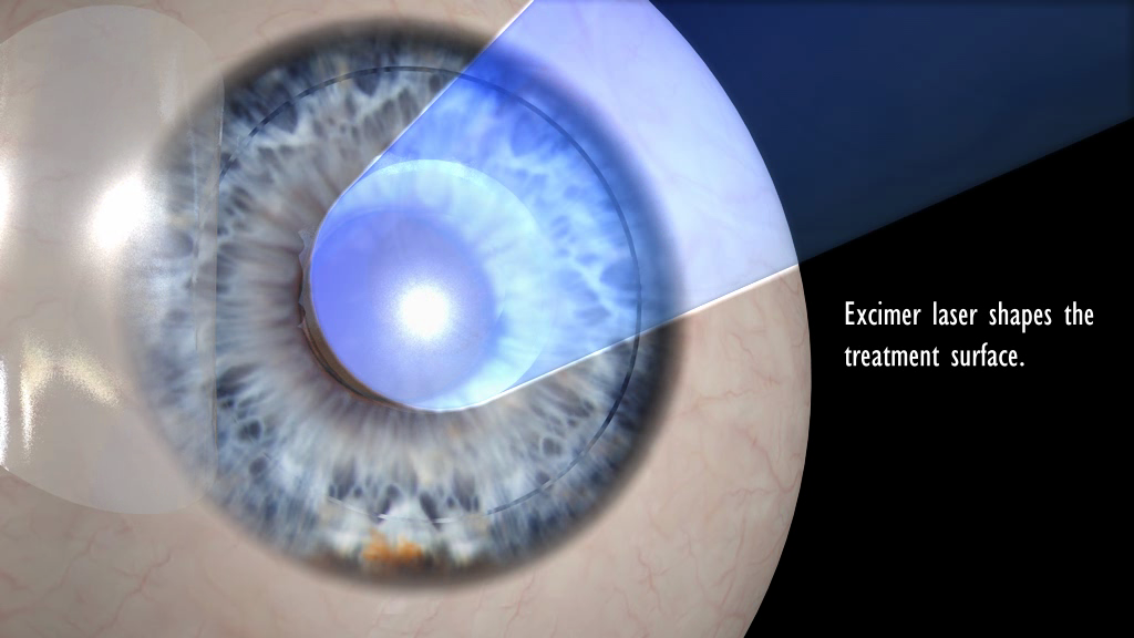 How ZLasik Works