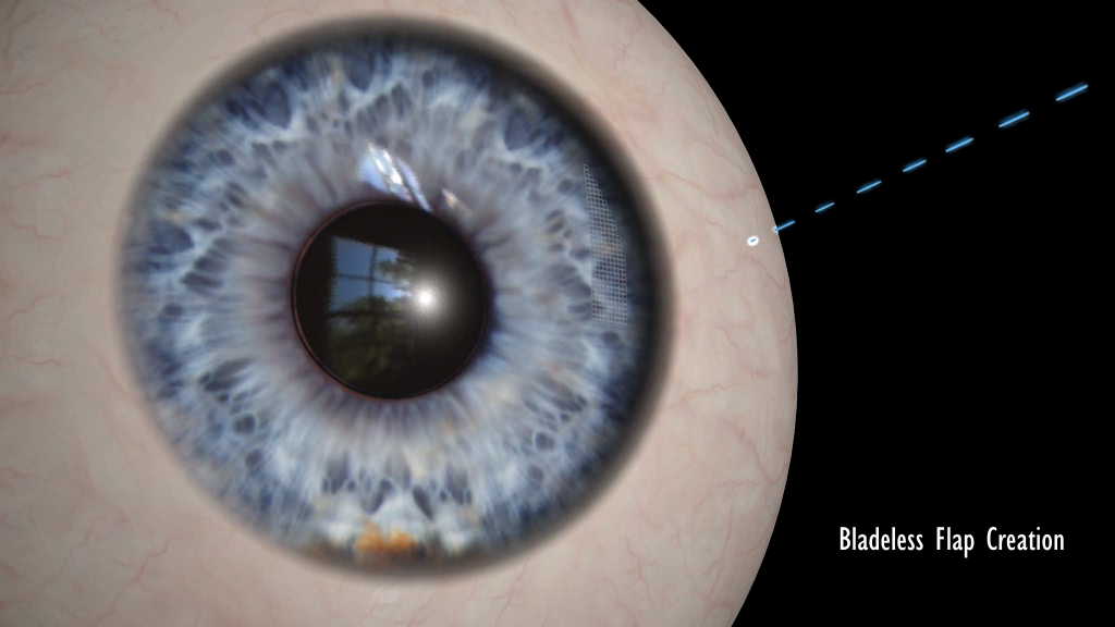 diagram of an eyeball undergoing LASIK treatment